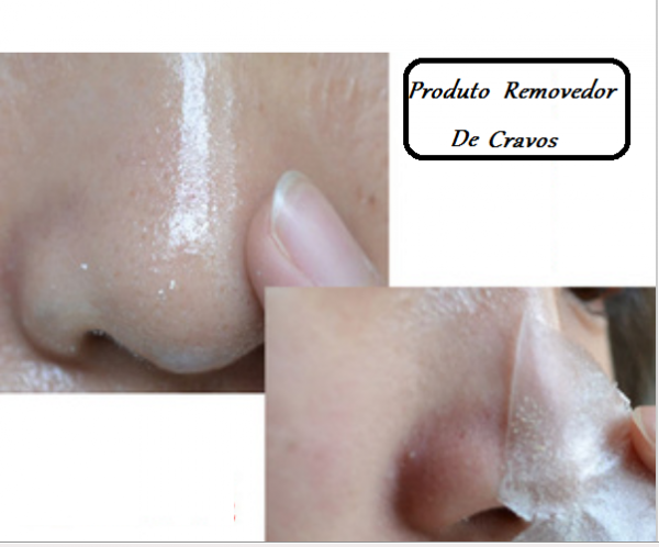 Solução para Conseguir que a Pele Perfeita Livre de Cravos